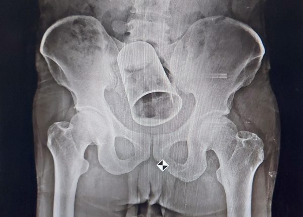 Gujarat Human Rights Commission seeks report on Steel Glass In Worker’s Intestine