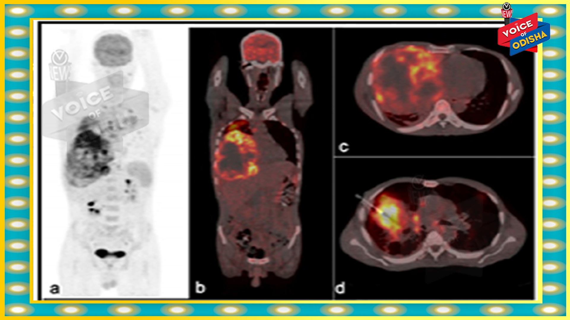 ଆପୋଲୋ ହସ୍ପିଟାଲରେ ଏହି ବିରଳ ରୋଗର ଚିକିତ୍ସା କରାଗଲା