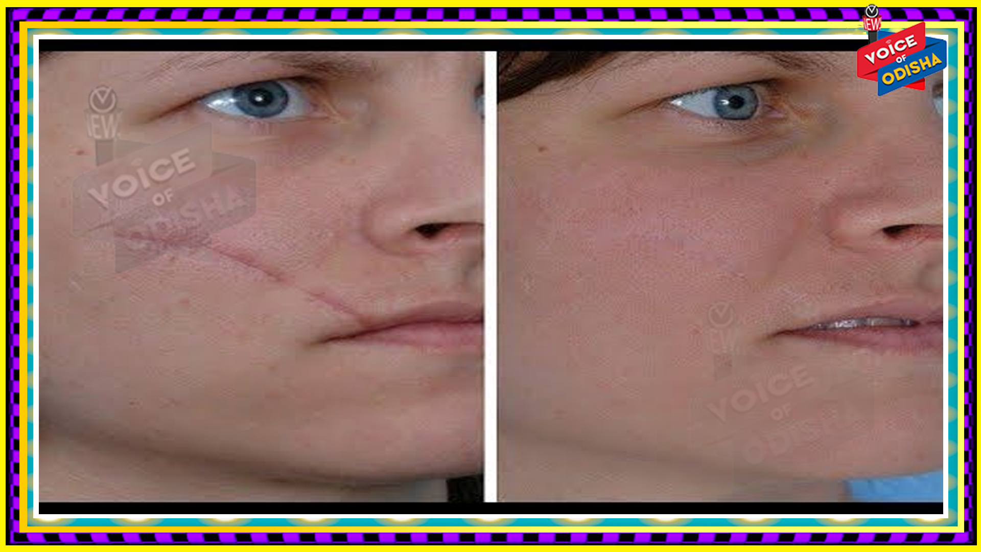 ଏହି ଉପାୟରେ ହଟାନ୍ତୁ ଘା’ ଦାଗ