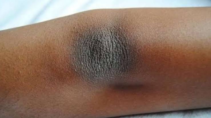 କହୁଣୀ କଳା ପଡ଼ିଛି କି...