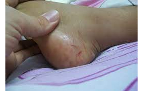 ସାପ କାମୁଡ଼ାରେ ମା’-ଝିଅ ମୃତ