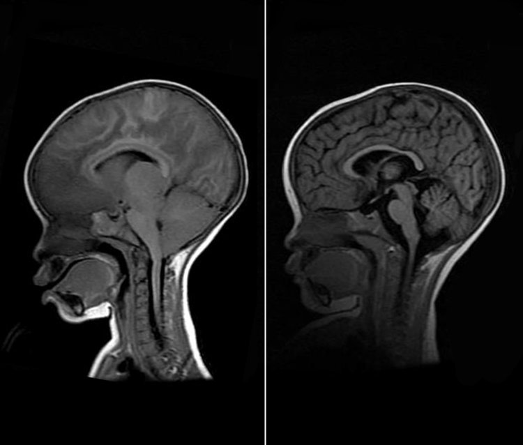 ବାହାରିଲା ବ୍ରେନ୍ ମ୍ୟାଲେରିଆ ଔଷଧ