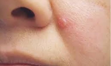 ଡ଼ରାଉଛି ତ୍ୱଚା କର୍କଟ ଭୟ