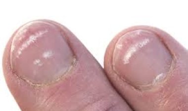 କାହିଁକି ନଖରେ ଧଳା ଦାଗ ଦେଖାଯାଏ