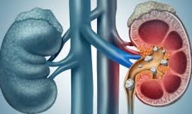 କିଡ଼ନୀ ଷ୍ଟୋନ ଲାଗି ମହୋଷଧି