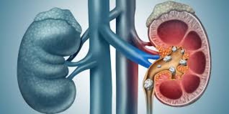 କିଡ଼ନୀ ଷ୍ଟୋନ ଲାଗି ମହୋଷଧି