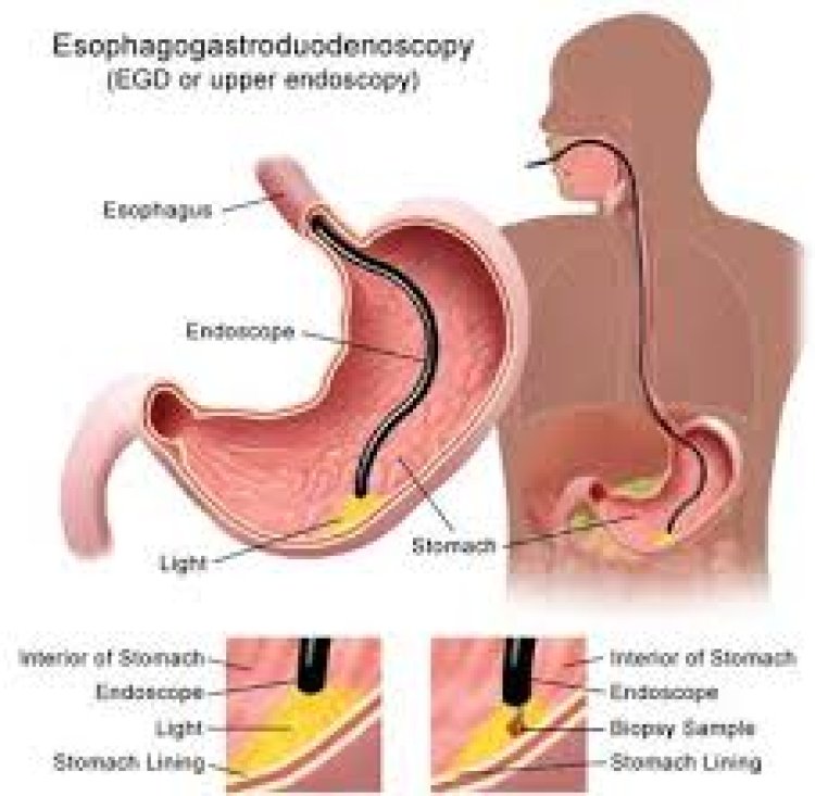 ଖାଦ୍ୟନଳୀର କ୍ୟାନସର୍