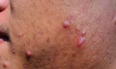 ଏହି କାରଣ ପାଇଁ ମୁହଁରେ ଉଠିଥାଏ ବ୍ରଣ, ବଦଳାନ୍ତୁ ନିଜର ଅଭ୍ୟାସ