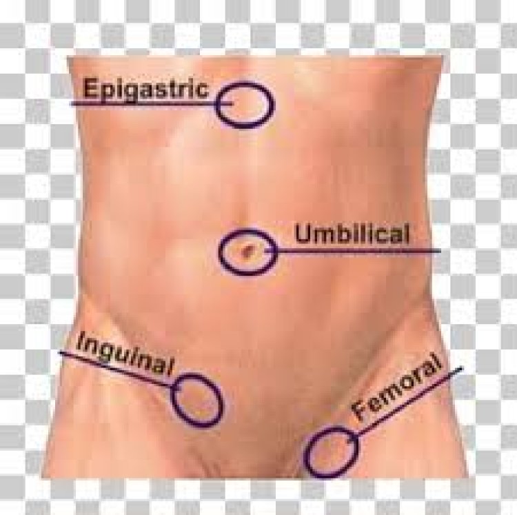 ହାର୍ନିୟାର ଲକ୍ଷଣକୁ ଅଣଦେଖା କରିବା ଉଚିତ୍ ନୁହେଁ