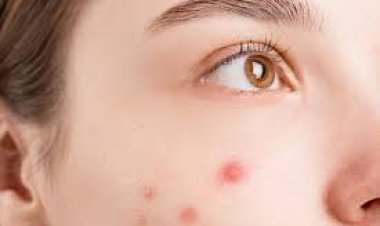 ଏହି କାରଣ ପାଇଁ ମୁହଁରେ ଉଠିଥାଏ ବ୍ରଣ, ବଦଳାନ୍ତୁ ନିଜର ଅଭ୍ୟାସ