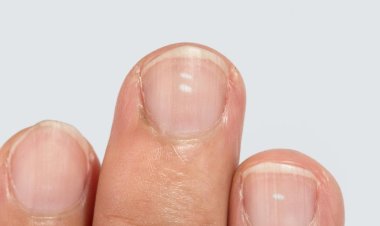 ଜାଣନ୍ତୁ, ନଖରେ ଧଳା ଦାଗ ରୋଗ କି ନୁହେଁ?