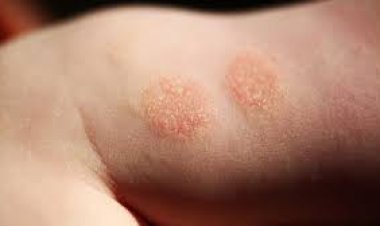 ଏକଜିମାର ଉପଯୋଗୀ  ଆୟୁର୍ବେଦିକ ଚିକିତ୍ସା