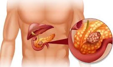 ସାବଧାନ! ଏହି ୫ ପ୍ରକାର ଲୋକଙ୍କୁ ହୋଇପାରେ ଲିଭର କ୍ୟାନସର