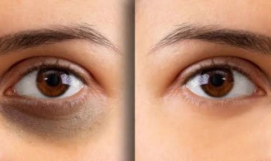 ଏହି ସାତଟି କାରଣ ପାଇଁ ହୋଇଥାଏ ଡାର୍କ ସର୍କଲ୍‌