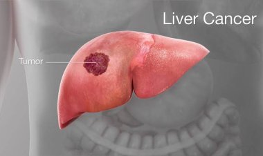 ସାବଧାନ! ଏହି ୫ ପ୍ରକାର ଲୋକଙ୍କୁ ହୋଇପାରେ ଲିଭର କ୍ୟାନସର