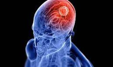 କାହିଁକି ହୁଏ ବ୍ରେନ ଟ୍ୟୁମର ?  ଜାଣନ୍ତୁ କାରଣ ଓ ଲକ୍ଷଣ