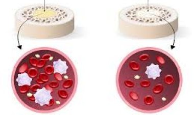 ଆଞ୍ଜିଓପ୍ଲାଷ୍ଟି କ’ଣ? କାହିଁକି ହୁଏ ?