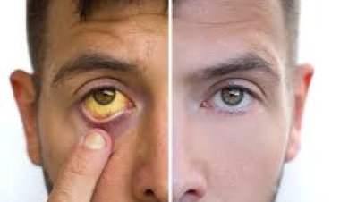 ଜାଣନ୍ତି କି? ଜଣ୍ଡିସ ରୋଗ କାହିଁକି ହୁଏ ଓ କେମିତି ହୁଏ?