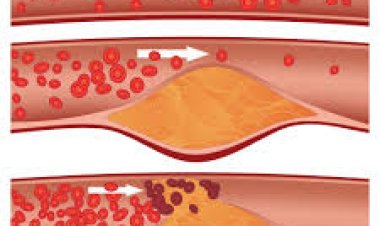 କୋଲେଷ୍ଟ୍ରଲ୍ କମାଇବାକୁ ପିଅନ୍ତୁ ଏହି ରସ