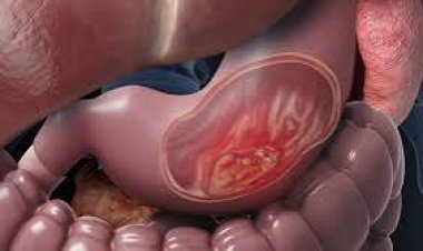 ଏହିସବୁ ଲକ୍ଷଣ ଥିଲେ ହୋଇପାରେ ପେଟରେ କ୍ୟାନସର୍ , ଜାଣନ୍ତୁ କାରଣ