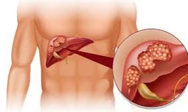 ସାବଧାନ! ଏହି ୫ ପ୍ରକାର ଲୋକଙ୍କୁ ହୋଇପାରେ ଲିଭର କ୍ୟାନସର